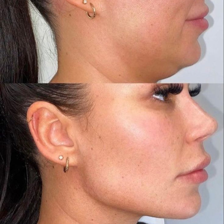 V-Line Rejuvenation Face Slimming Strap™